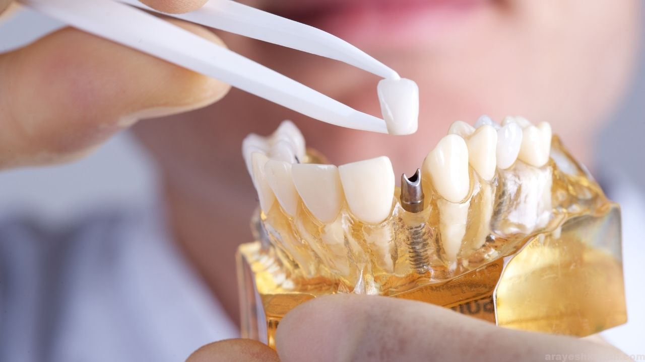 شرایط سنی ایمپلنت دندان