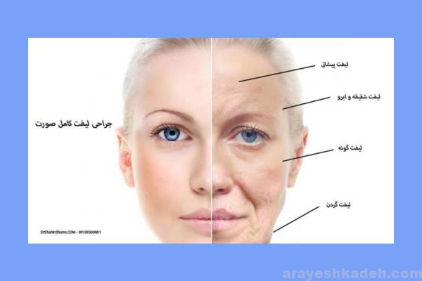 بهترین جراح لیفت صورت تهران لیفت صورت و انواع آن در نواحی مختلف صورت