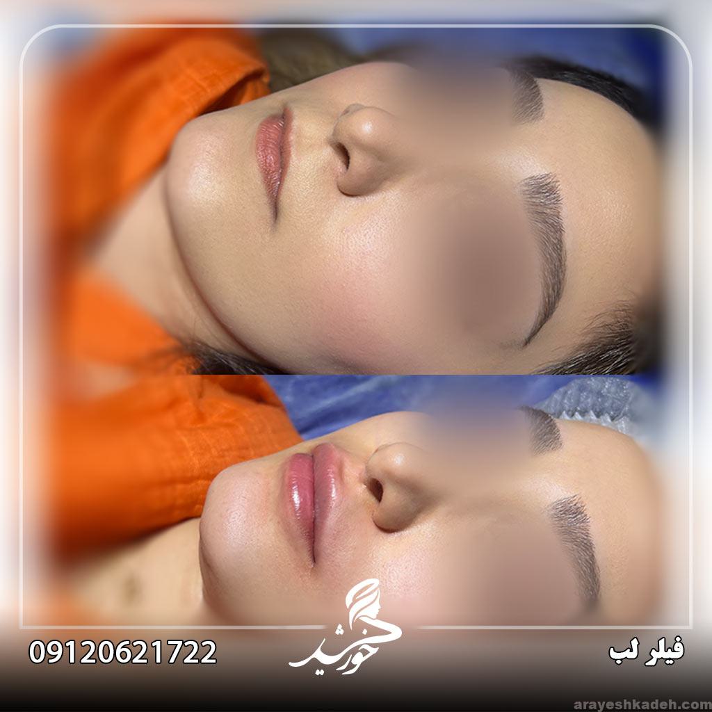 هزینه فیلر صورت چقدر است؟ فیلر-صورت-کلینیک-خورشید-تهران