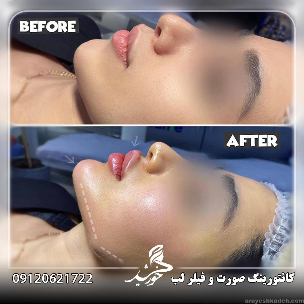 هزینه فیلر صورت چقدر است؟ فیلر-صورت-کلینیک-خورشید-قیطریه-تهران