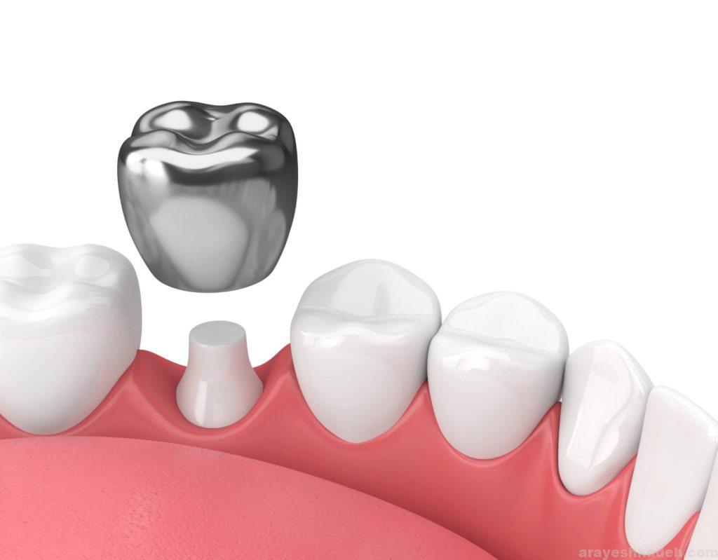معرفی کامل 5 نوع روکش موقت دندان شیری + راههای مراقبت از آنها image 22