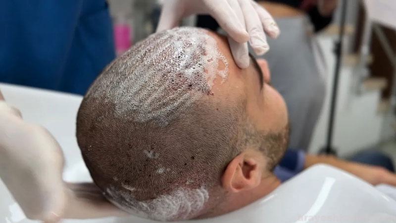 مراقبتهای بعد از کاشت مو