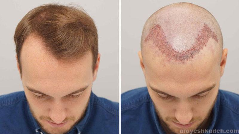 کاشت موی سر و اهمیت انتخاب روش مناسب